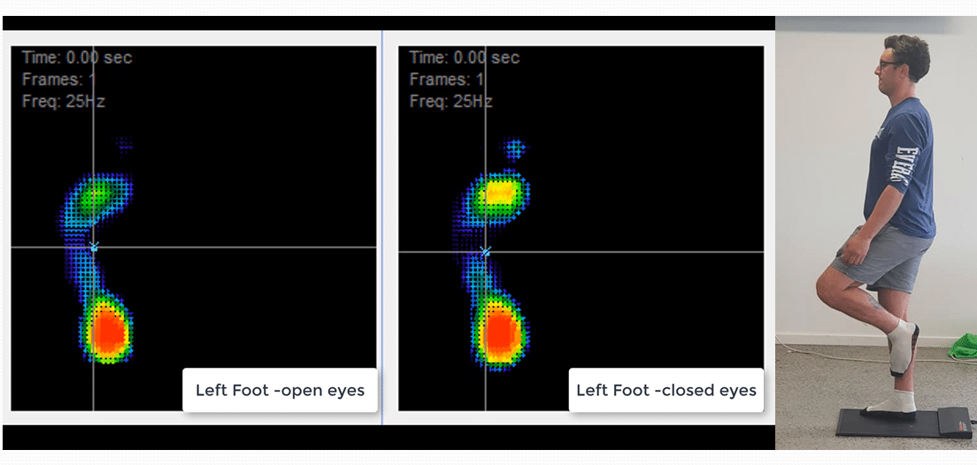 Balance Assessment using Plantar Pressure Analysis Stepforce